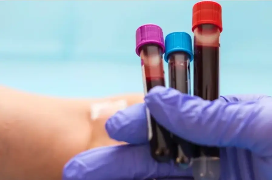 There’s a Blood Test for Alzheimer’s